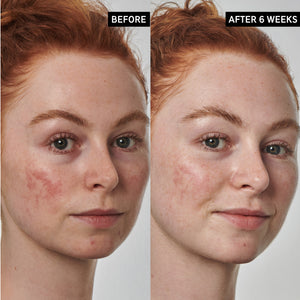 Before and after results of using Redness Relief Solution for 6 weeks
