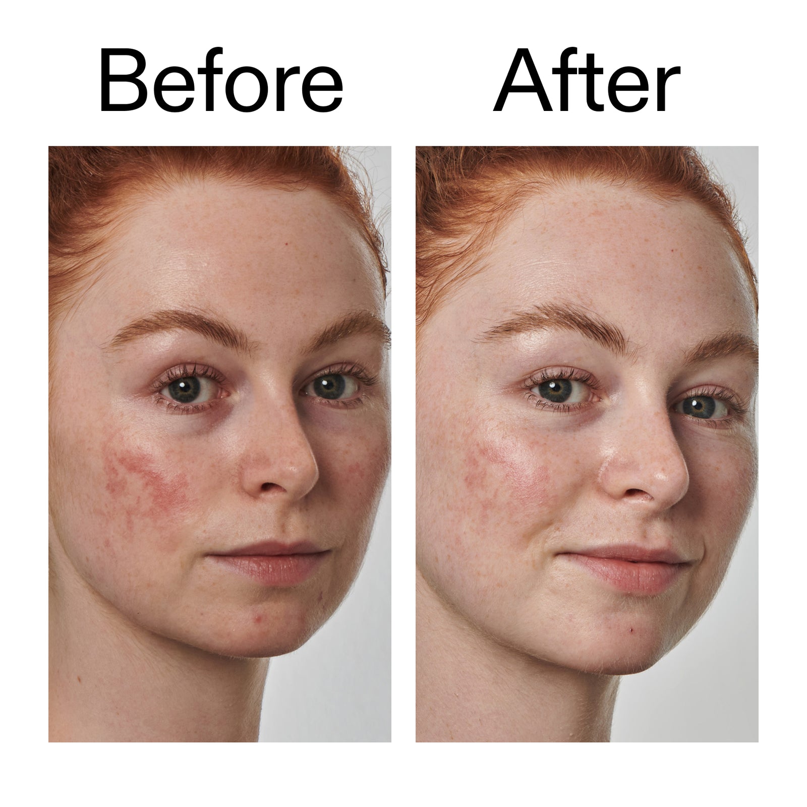 Before and after comparison of a person with acne on their face.