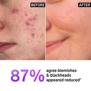 Supersize Salicylic Acid Cleanser Duo before and after with key claim statistic