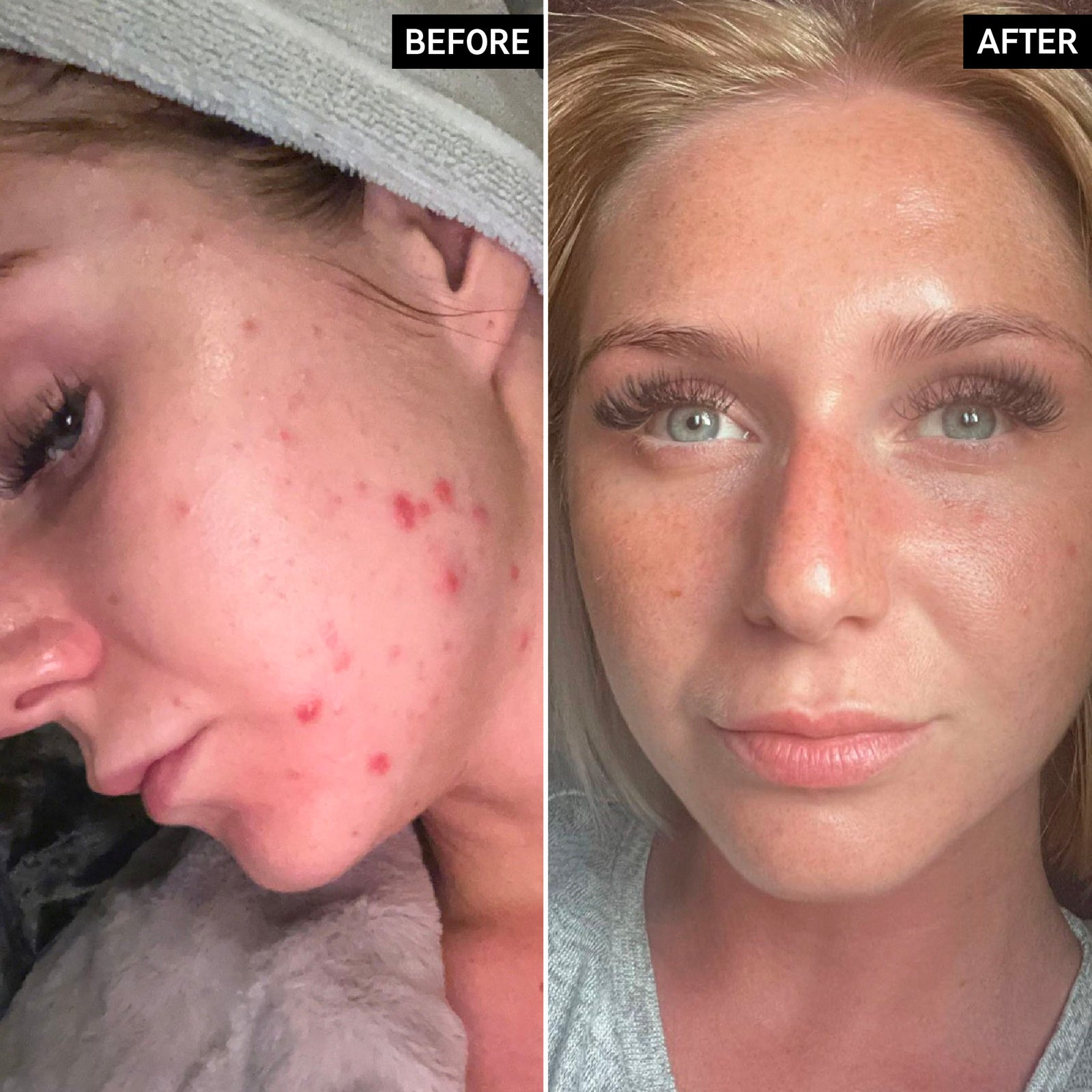 Before and After of customer using Beta Hydroxy Acid Showing reduced redness and blemishes 