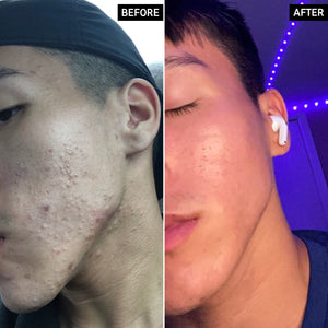 Before and After using Anti-Acne Cleanse Duo