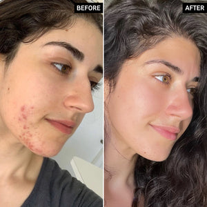 Before and after of using The Intro routine for acne