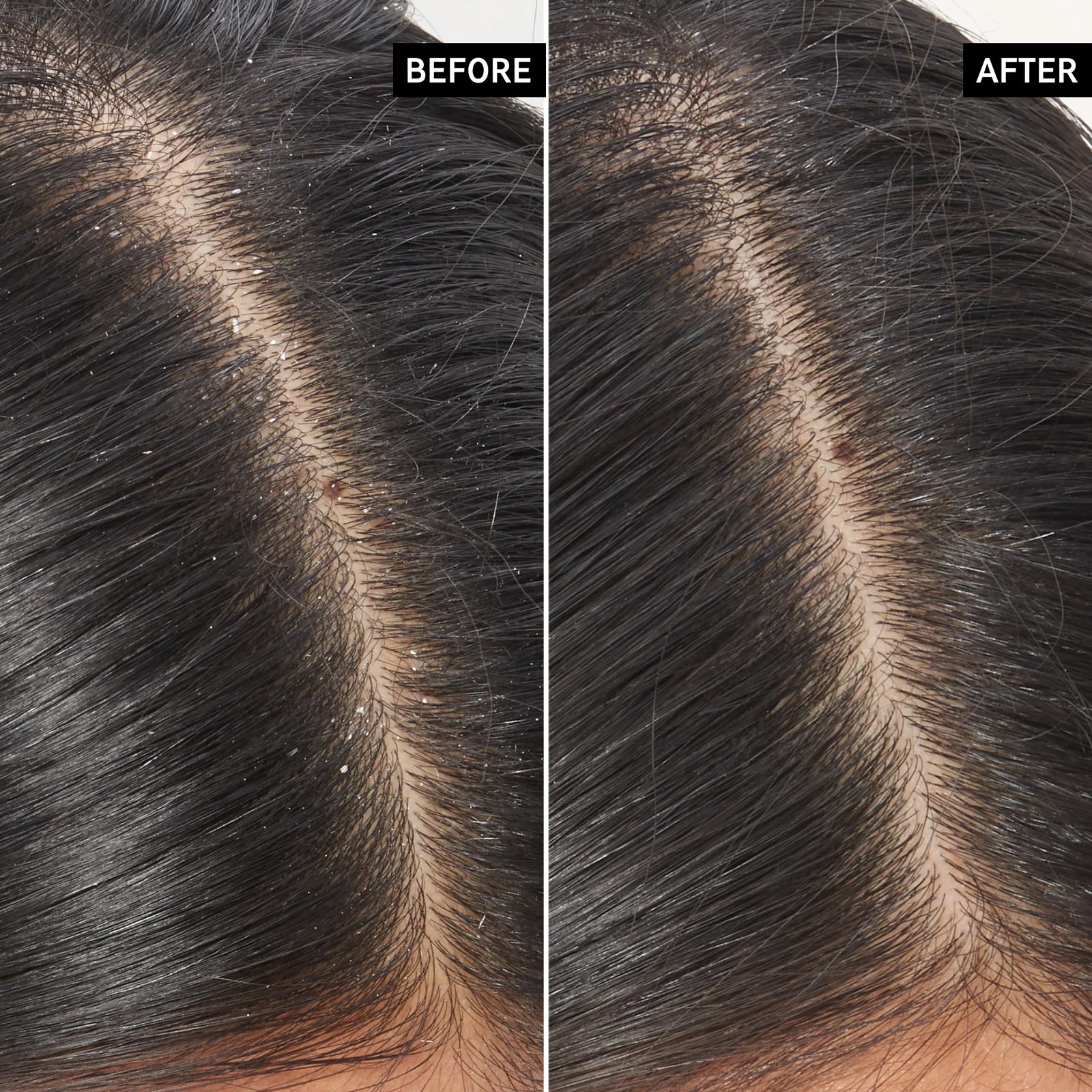 Before and after of using Salicylic Acid scalp treament