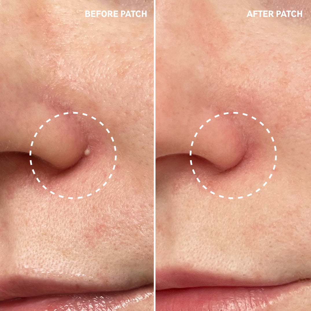 Hydrocolloid Acne Pimple Patch