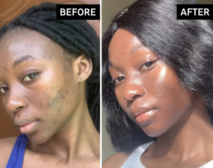 Before and after comparison of a woman's face with visible skin concerns.