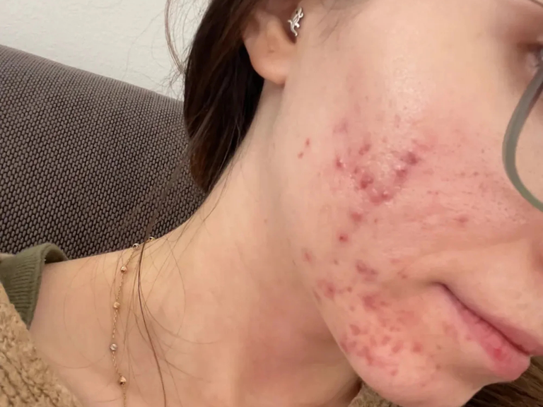 Close-up of a person's face with visible acne on a neutral background