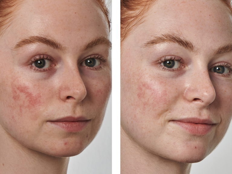 A side-by-side close-up comparison of a woman's face showing skin improvement, with redness and blemishes visible on the left panel and clearer skin on the right panel against a light gray background.