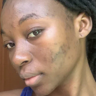 Close-up of a person's face showing skin texture, blemishes, and dark hair against a neutral indoor background.