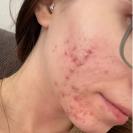 Close-up of a person's cheek and jawline showing severe acne, blemishes, and red inflammatory spots on the skin.