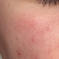 Close-up of a person's face showing red acne blemishes and skin texture on the cheek area.