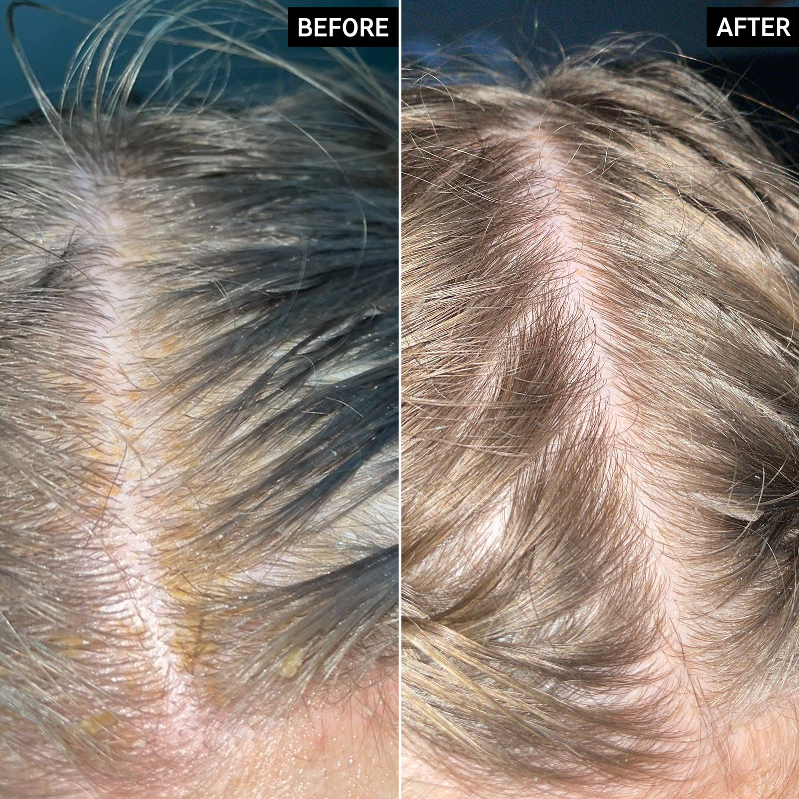 Before and After images of a customer's scalp, having used Salicylic Acid Exfoliating Scalp Treatment for 6 weeks.