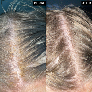 Before and After images of a customer's scalp, having used Salicylic Acid Exfoliating Scalp Treatment for 6 weeks.