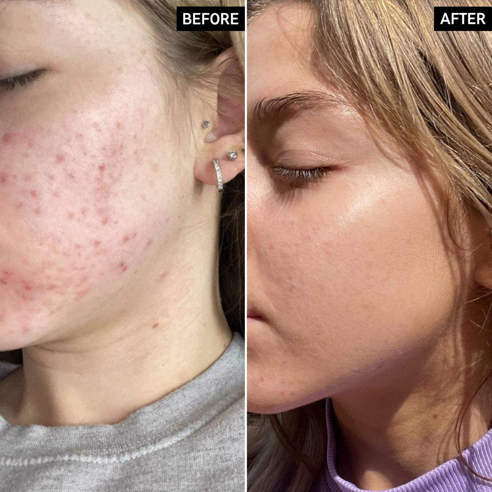 Before & After of customer using Niacinmide Serum
