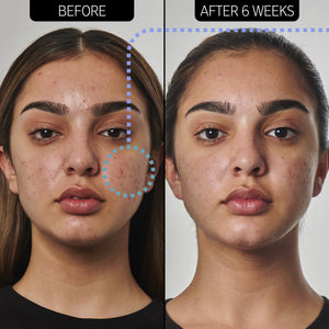 2 images of a woman's face side by side to show before and after using Acne Solution for 6 weeks
